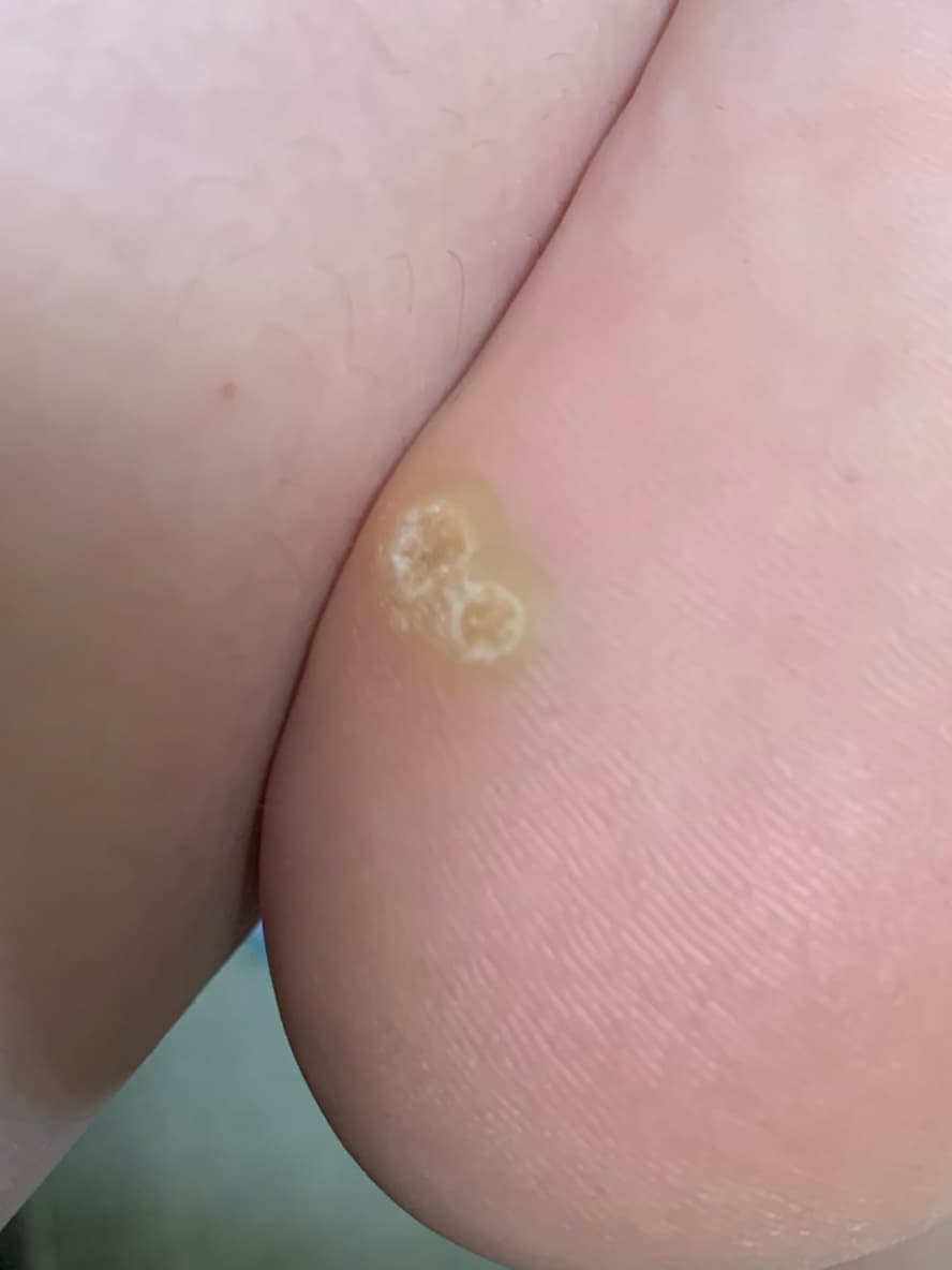 Plantar wart clusters